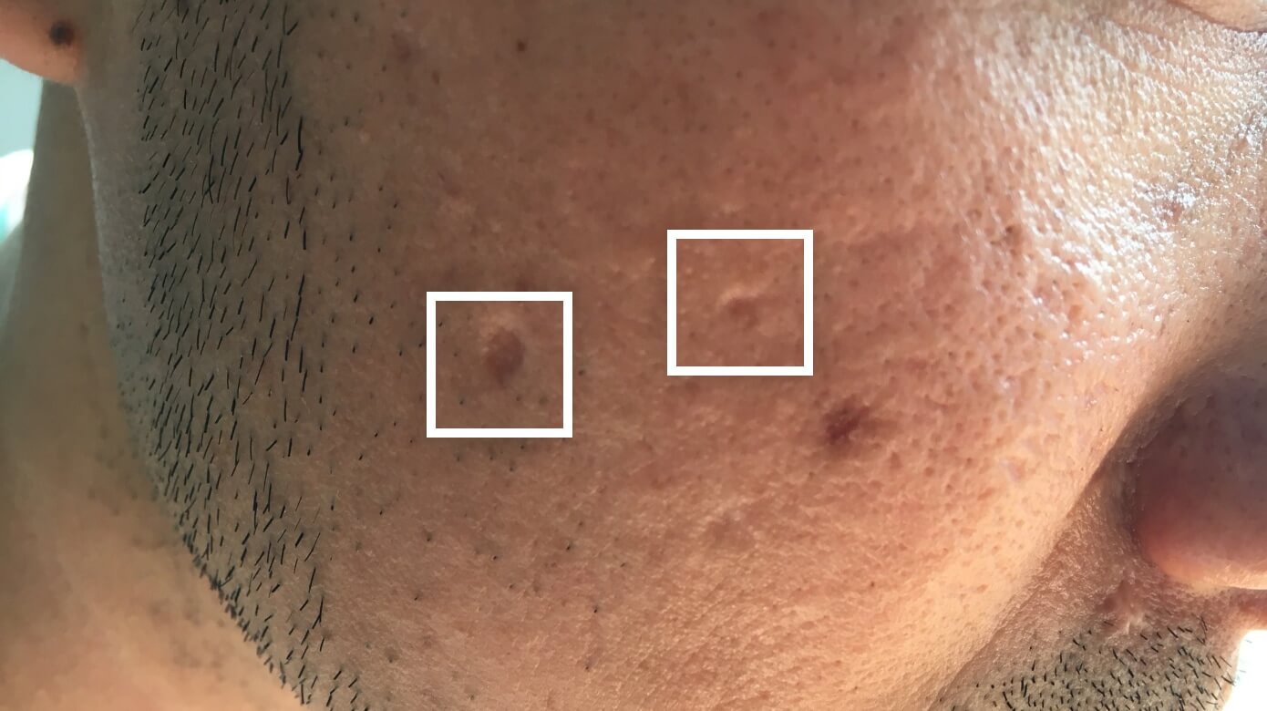 Box scars