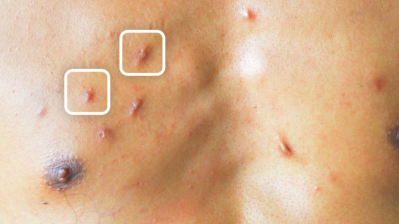 Keloid acne scar on chest
