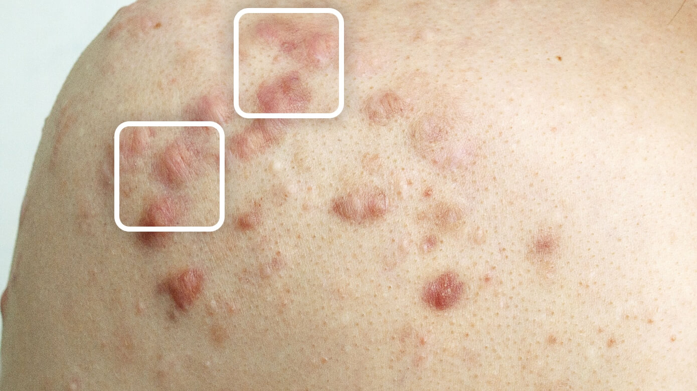 Keloid acne scar