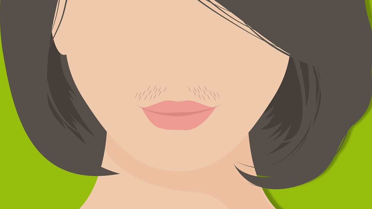 What is hirsutism?