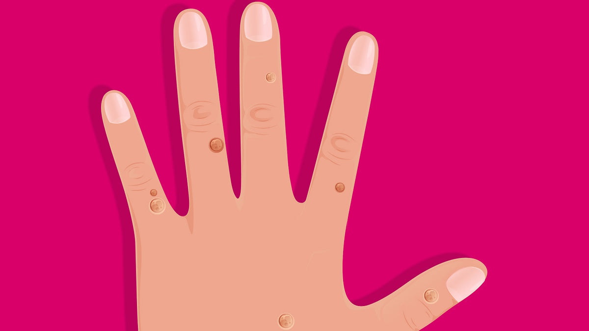 HPV warts: everything you need to know