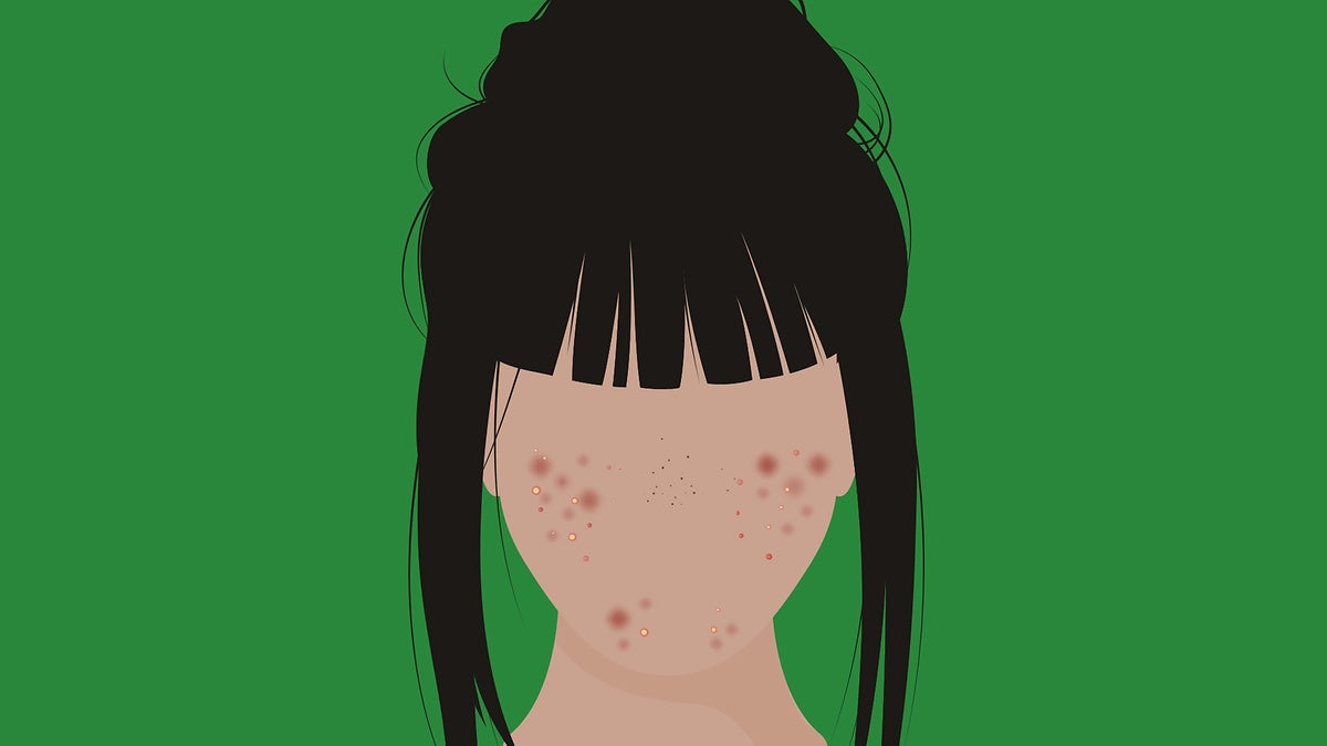 What is cystic acne?