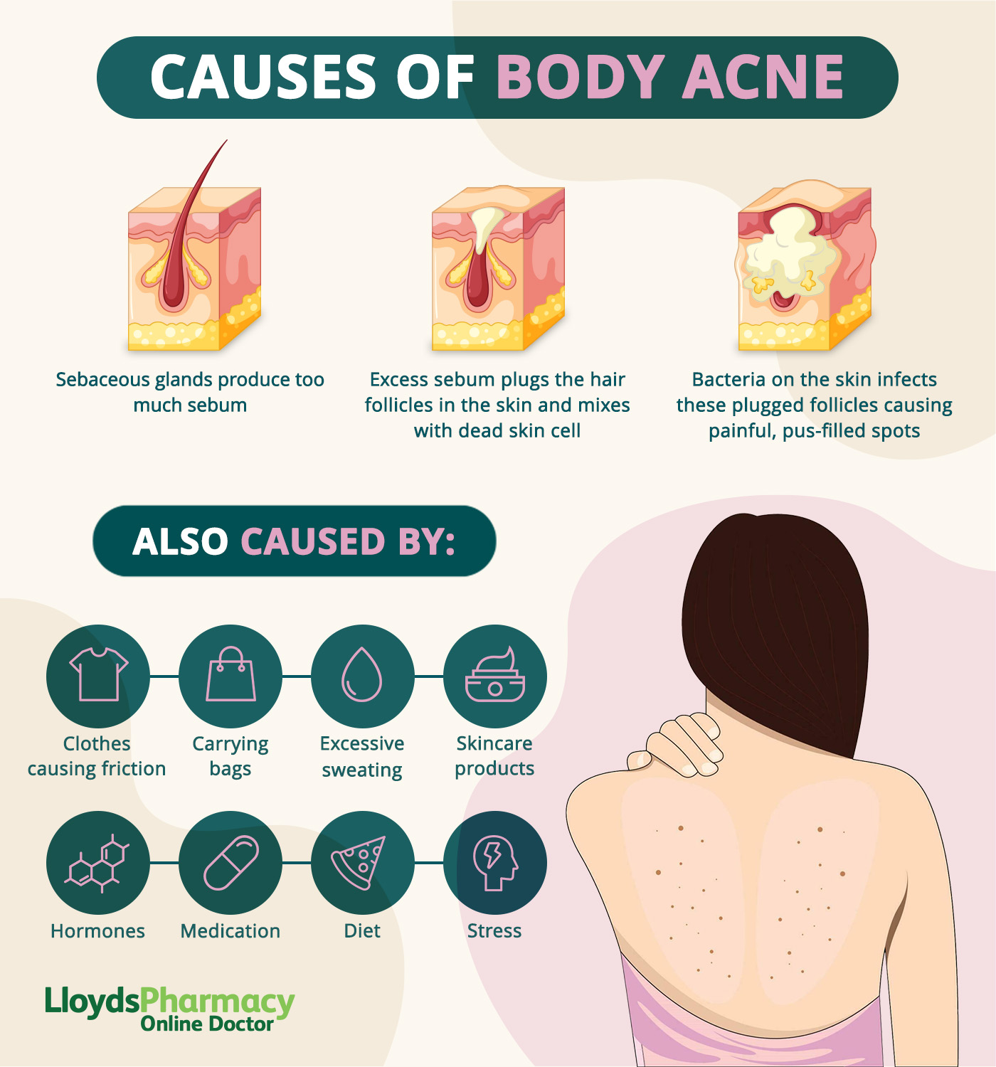 Causes of chest and back acne