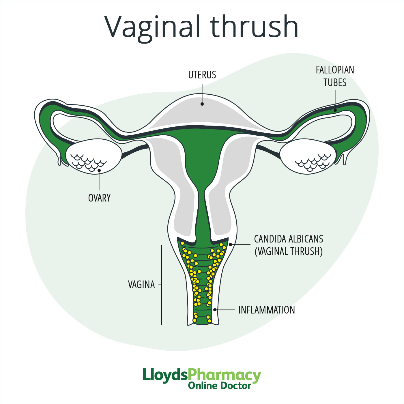 female thrush infection