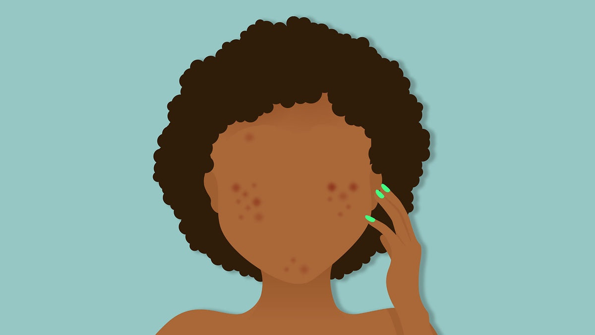 Female acne