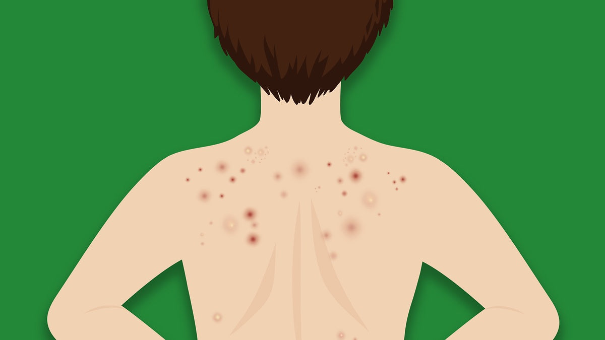 Understanding 'bacne' and male acne