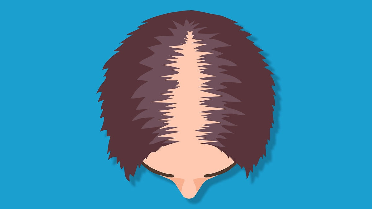 How to deal with alopecia