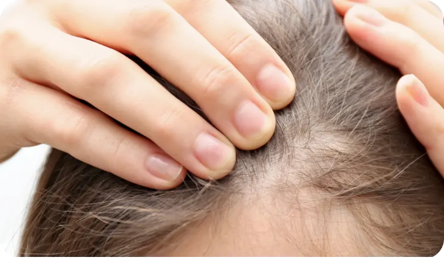 Women's hair loss